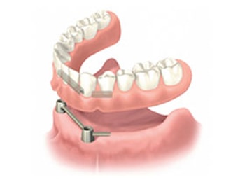 Tandprothese behandeling dentuelle tandlabo zelzate