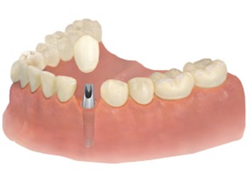 implantaten behandeling tandlabo dentuelle zelzate