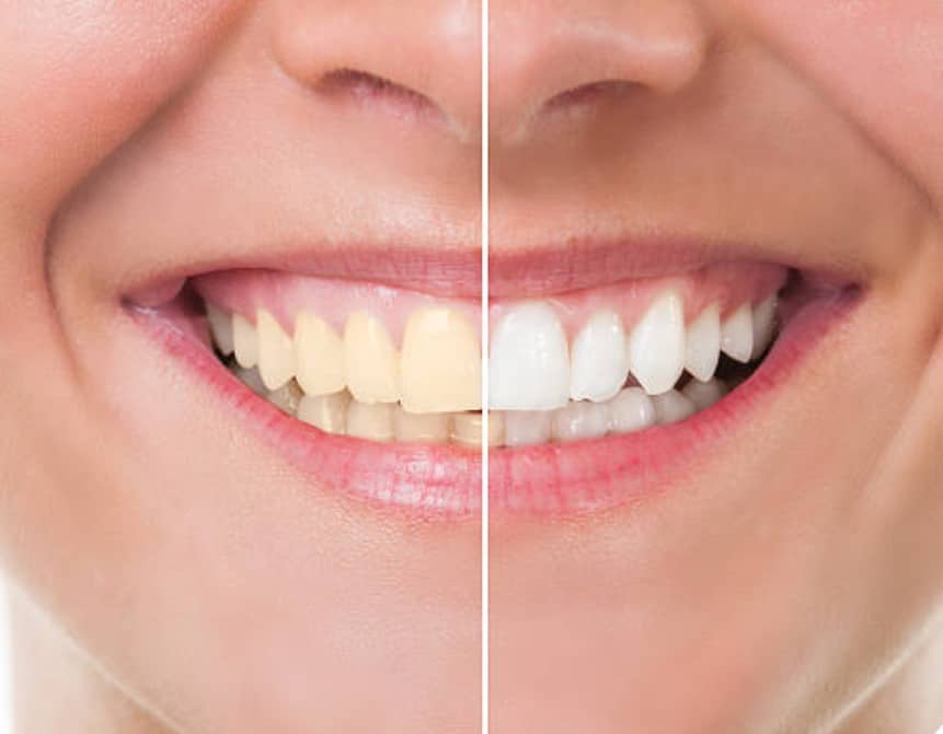 reiniging tandprothese tandlabo dentuelle delaruelle zelzate